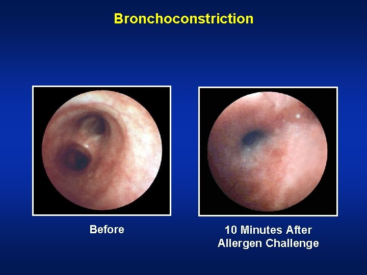 Bronchoconstriction Before 10 Minutes After Allergen Challenge  Bronchoconstriction Before 10 Minutes After Allergen Challenge