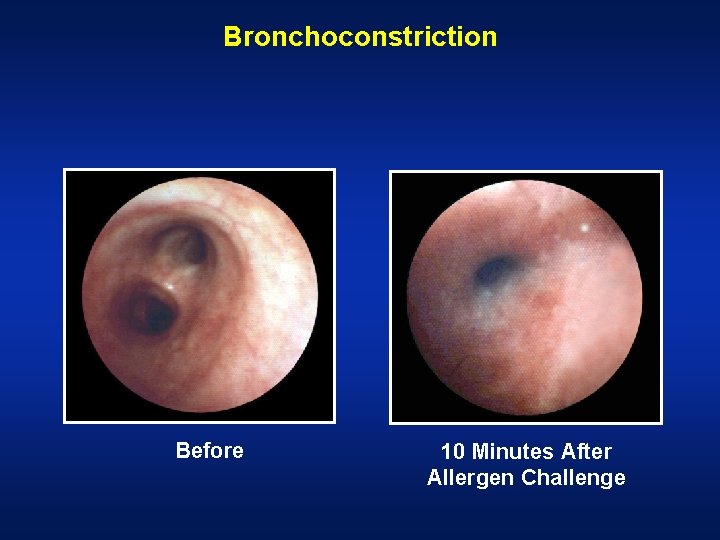 Bronchoconstriction Before 10 Minutes After Allergen Challenge 