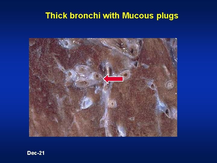 Thick bronchi with Mucous plugs Dec-21  Thick bronchi with Mucous plugs Dec-21