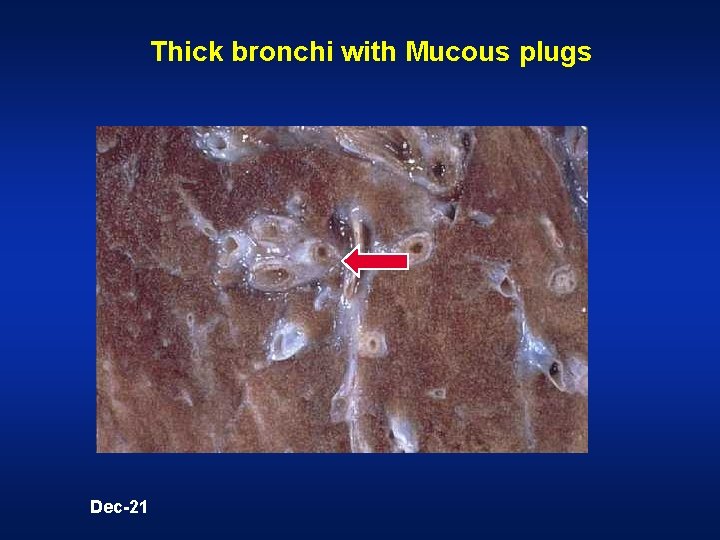 Thick bronchi with Mucous plugs Dec-21 