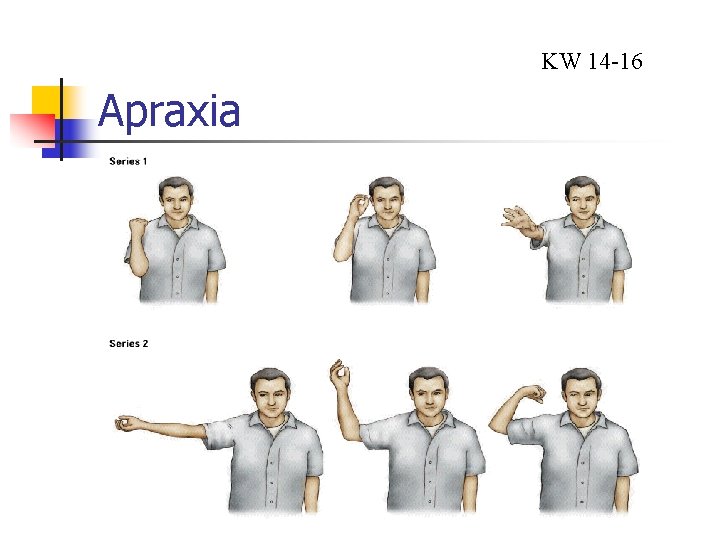 KW 14 -16 Apraxia 