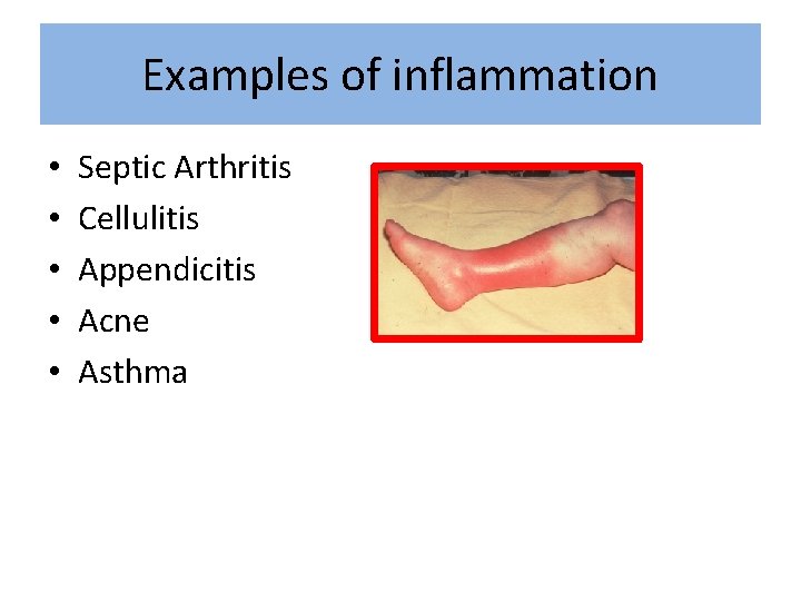 Examples of inflammation • • • Septic Arthritis Cellulitis Appendicitis Acne Asthma 
