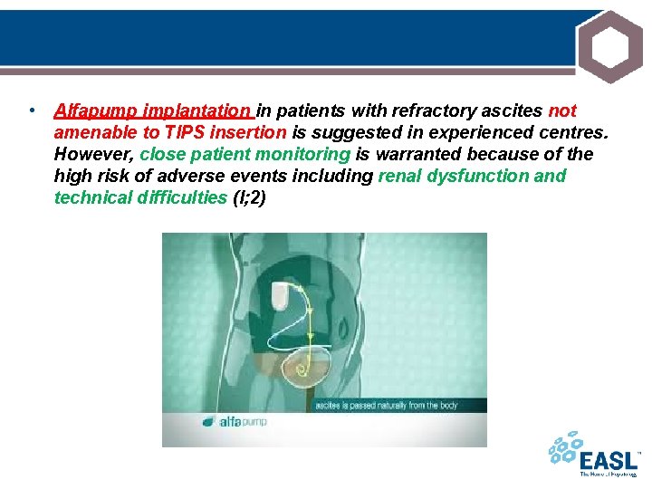  • Alfapump implantation in patients with refractory ascites not amenable to TIPS insertion