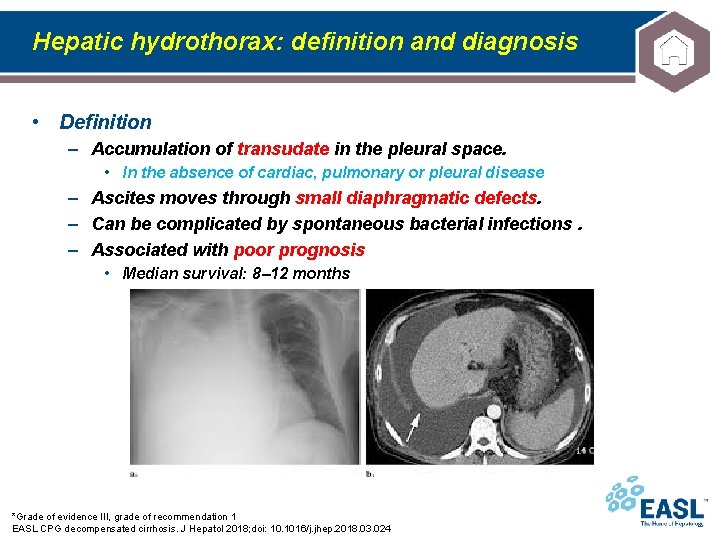 Hepatic hydrothorax: definition and diagnosis • Definition – Accumulation of transudate in the pleural