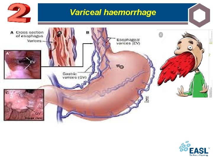 Variceal haemorrhage 