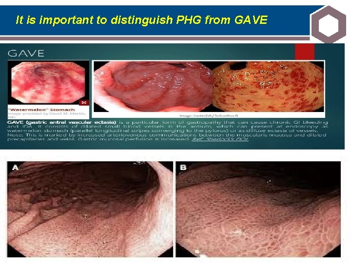 It is important to distinguish PHG from GAVE 