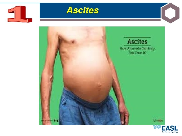 Ascites 