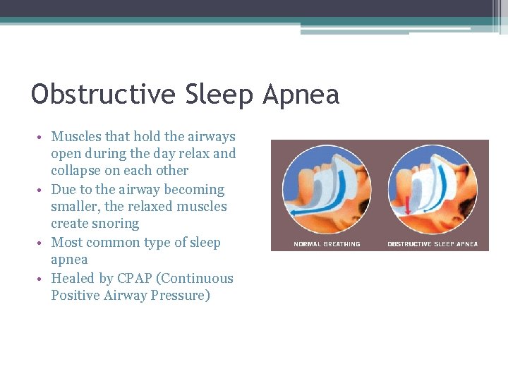 Obstructive Sleep Apnea • Muscles that hold the airways open during the day relax