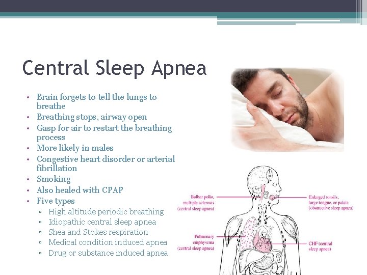 Central Sleep Apnea • Brain forgets to tell the lungs to breathe • Breathing