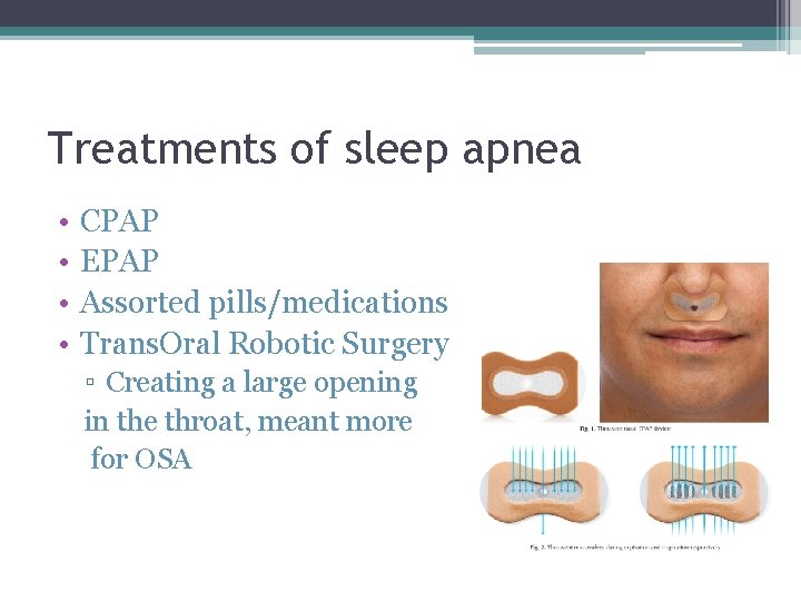 Treatments of sleep apnea • • CPAP EPAP Assorted pills/medications Trans. Oral Robotic Surgery