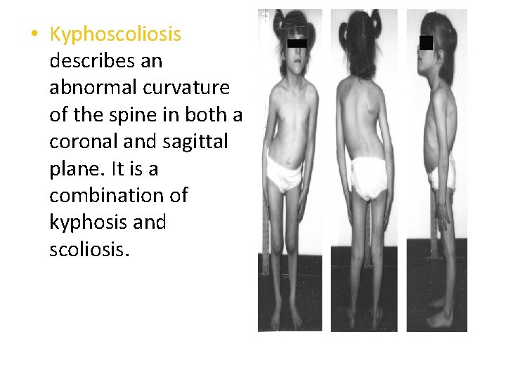  • Kyphoscoliosis describes an abnormal curvature of the spine in both a coronal
