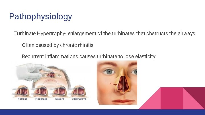 Pathophysiology Turbinate Hypertrophy- enlargement of the turbinates that obstructs the airways Often caused by