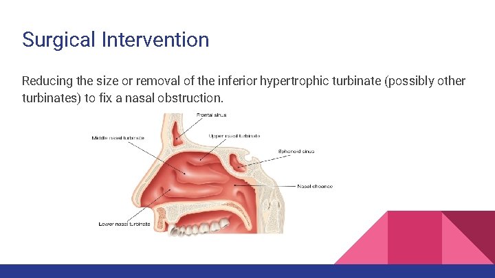 Surgical Intervention Reducing the size or removal of the inferior hypertrophic turbinate (possibly other