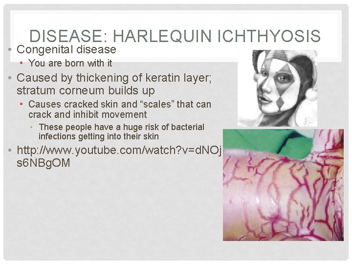 DISEASE: HARLEQUIN ICHTHYOSIS • Congenital disease • You are born with it • Caused