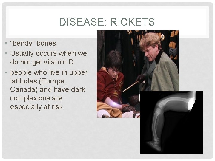 DISEASE: RICKETS • “bendy” bones • Usually occurs when we do not get vitamin