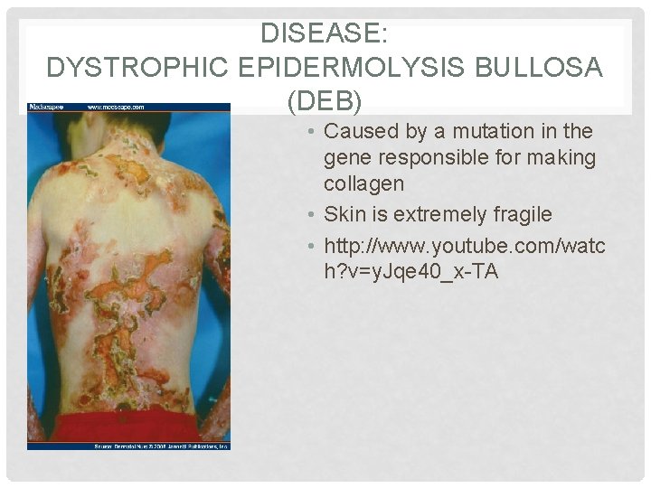 DISEASE: DYSTROPHIC EPIDERMOLYSIS BULLOSA (DEB) • Caused by a mutation in the gene responsible