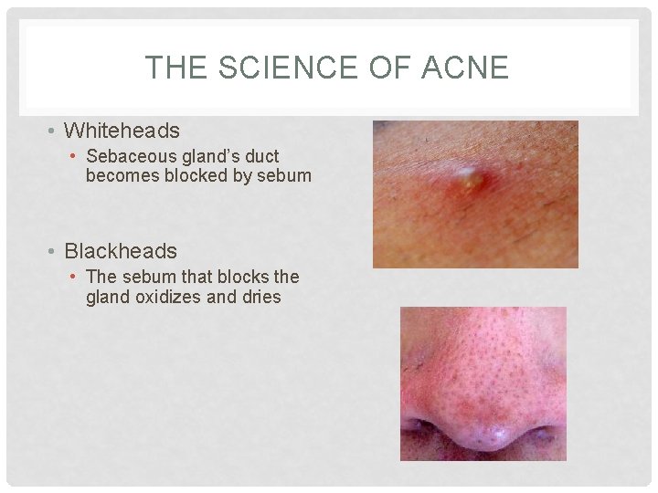 THE SCIENCE OF ACNE • Whiteheads • Sebaceous gland’s duct becomes blocked by sebum