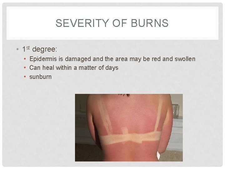 SEVERITY OF BURNS • 1 st degree: • Epidermis is damaged and the area