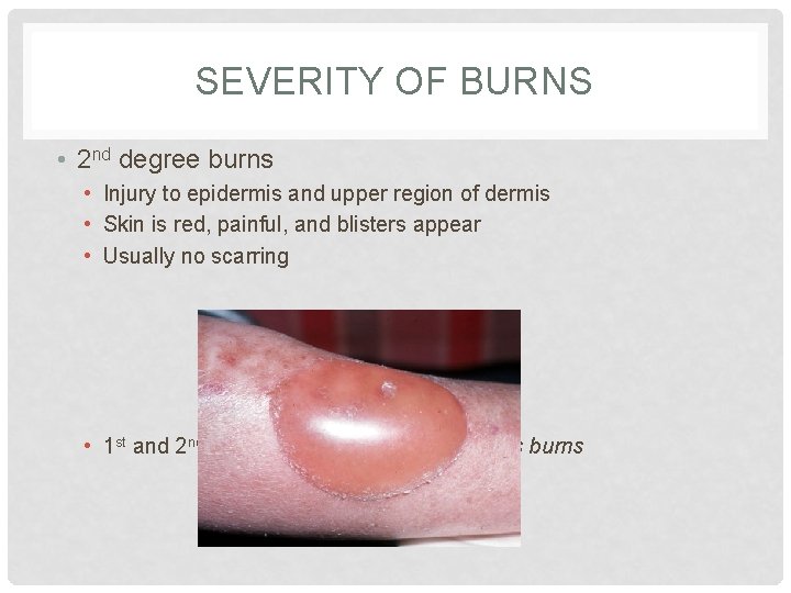 SEVERITY OF BURNS • 2 nd degree burns • Injury to epidermis and upper