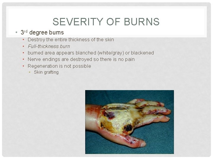 SEVERITY OF BURNS • 3 rd degree burns • • • Destroy the entire