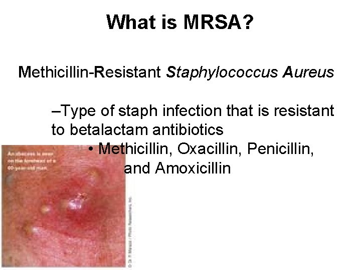What is MRSA? Methicillin-Resistant Staphylococcus Aureus –Type of staph infection that is resistant to
