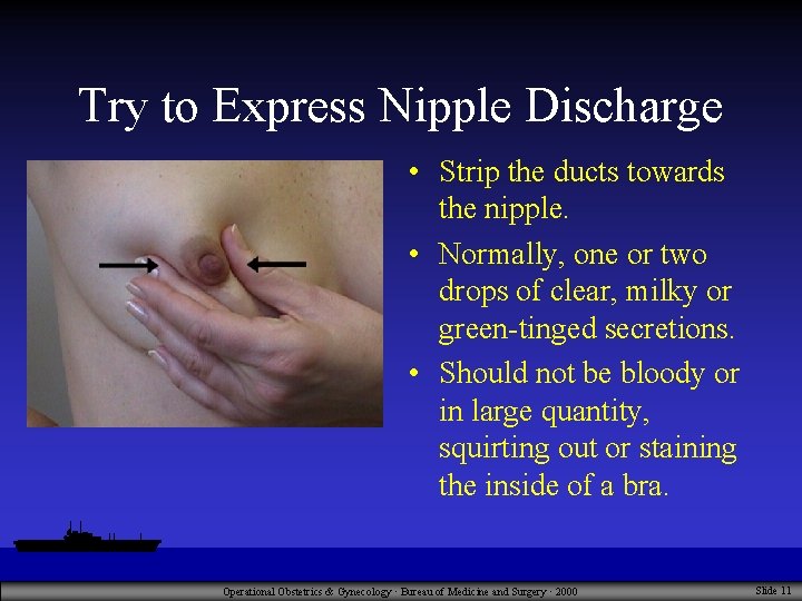 Try to Express Nipple Discharge • Strip the ducts towards the nipple. • Normally,