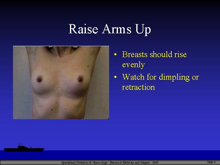 Raise Arms Up • Breasts should rise evenly • Watch for dimpling or retraction