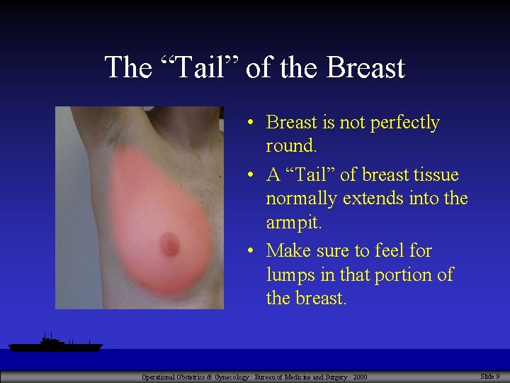 The “Tail” of the Breast • Breast is not perfectly round. • A “Tail”