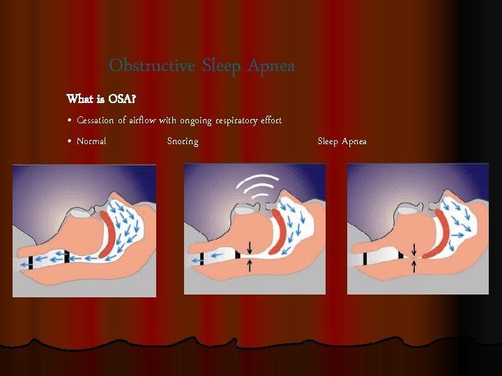 Obstructive Sleep Apnea What is OSA? • Cessation of airflow with ongoing respiratory effort