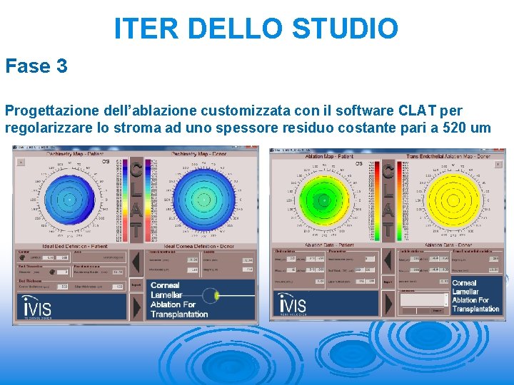 ITER DELLO STUDIO Fase 3 Progettazione dell’ablazione customizzata con il software CLAT per regolarizzare