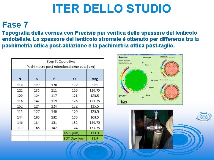 ITER DELLO STUDIO Fase 7 Topografia della cornea con Precisio per verifica dello spessore