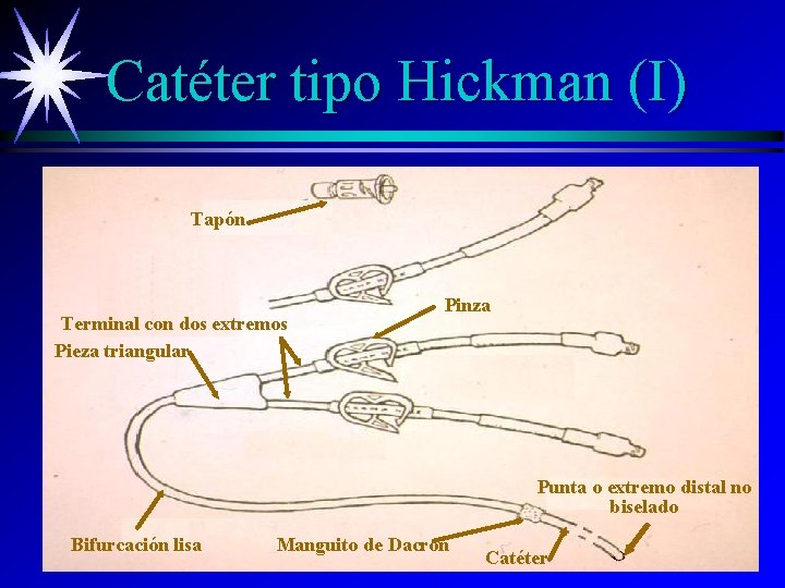 Catéter tipo Hickman (I) Tapón Terminal con dos extremos Pieza triangular Pinza Punta o