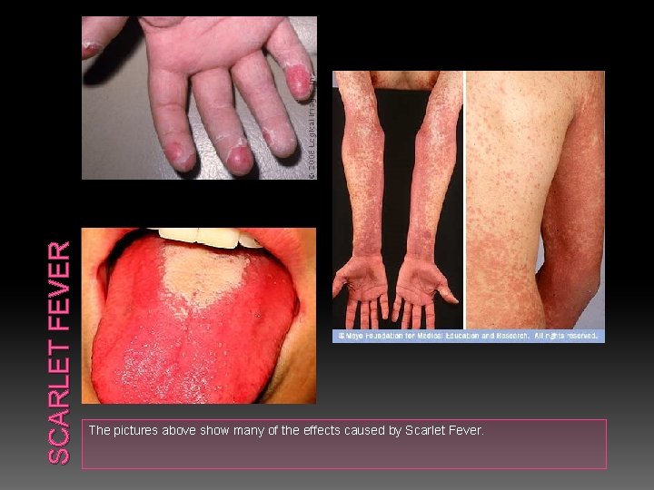 SCARLET FEVER The pictures above show many of the effects caused by Scarlet Fever.