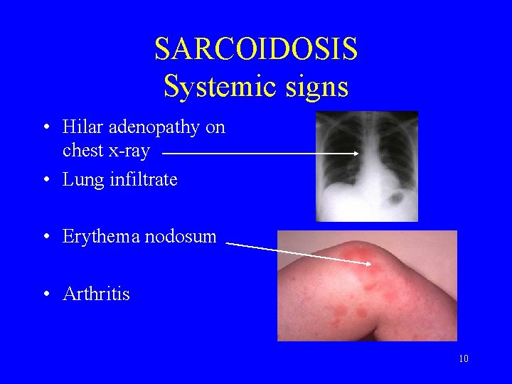 SARCOIDOSIS Systemic signs • Hilar adenopathy on chest x-ray • Lung infiltrate • Erythema