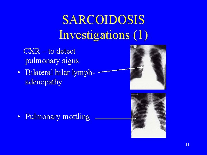 SARCOIDOSIS Investigations (1) CXR – to detect pulmonary signs • Bilateral hilar lymphadenopathy •