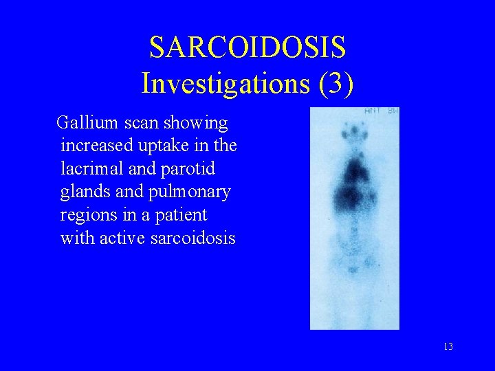 SARCOIDOSIS Investigations (3) Gallium scan showing increased uptake in the lacrimal and parotid glands