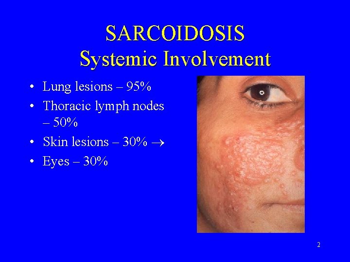 SARCOIDOSIS Systemic Involvement • Lung lesions – 95% • Thoracic lymph nodes – 50%