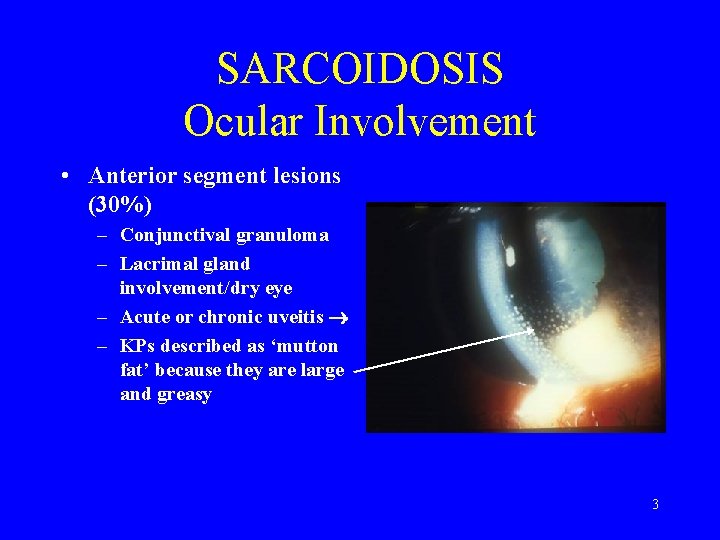 SARCOIDOSIS Ocular Involvement • Anterior segment lesions (30%) – Conjunctival granuloma – Lacrimal gland