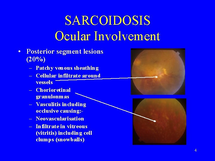 SARCOIDOSIS Ocular Involvement • Posterior segment lesions (20%) – Patchy venous sheathing – Cellular