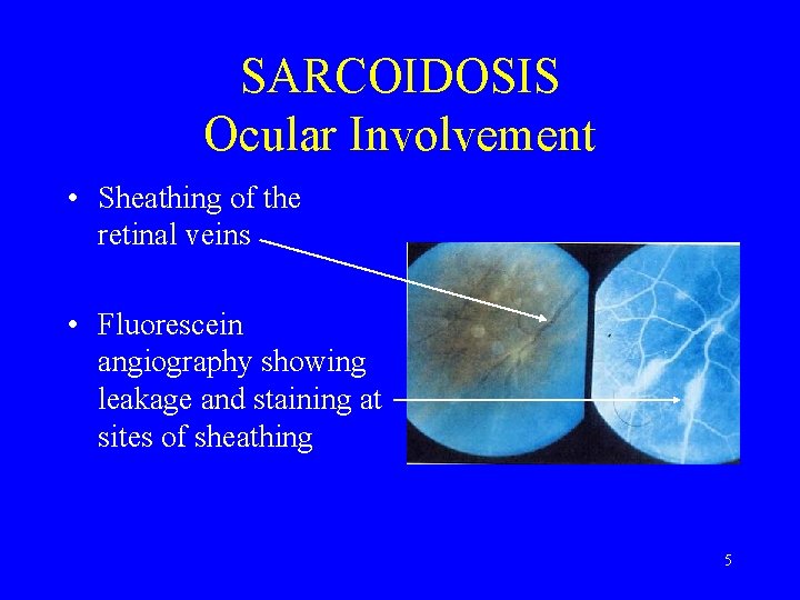 SARCOIDOSIS Ocular Involvement • Sheathing of the retinal veins • Fluorescein angiography showing leakage