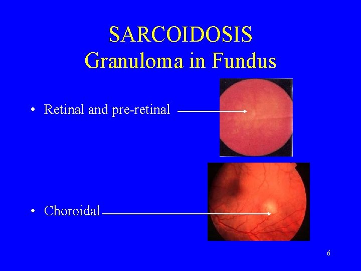 SARCOIDOSIS Granuloma in Fundus • Retinal and pre-retinal • Choroidal 6 