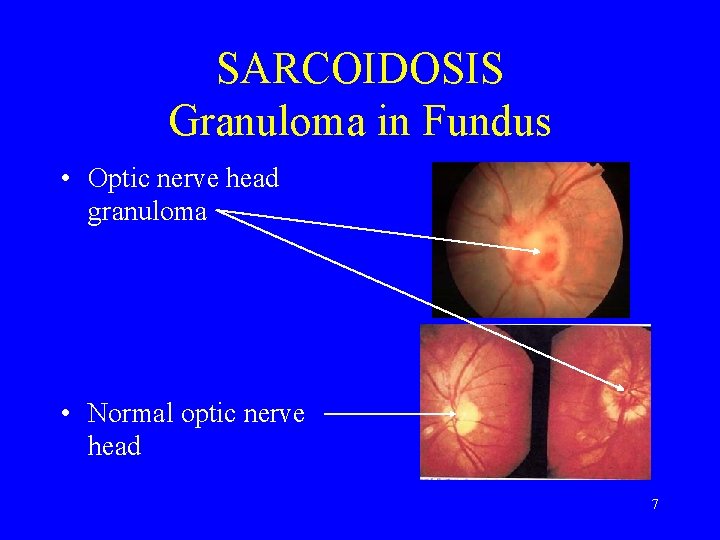 SARCOIDOSIS Granuloma in Fundus • Optic nerve head granuloma • Normal optic nerve head