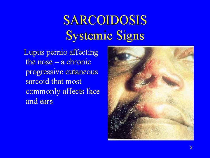 SARCOIDOSIS Systemic Signs Lupus pernio affecting the nose – a chronic progressive cutaneous sarcoid