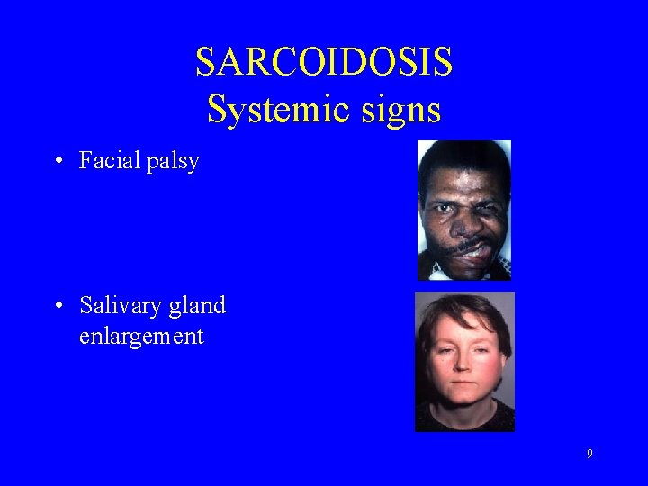 SARCOIDOSIS Systemic signs • Facial palsy • Salivary gland enlargement 9 