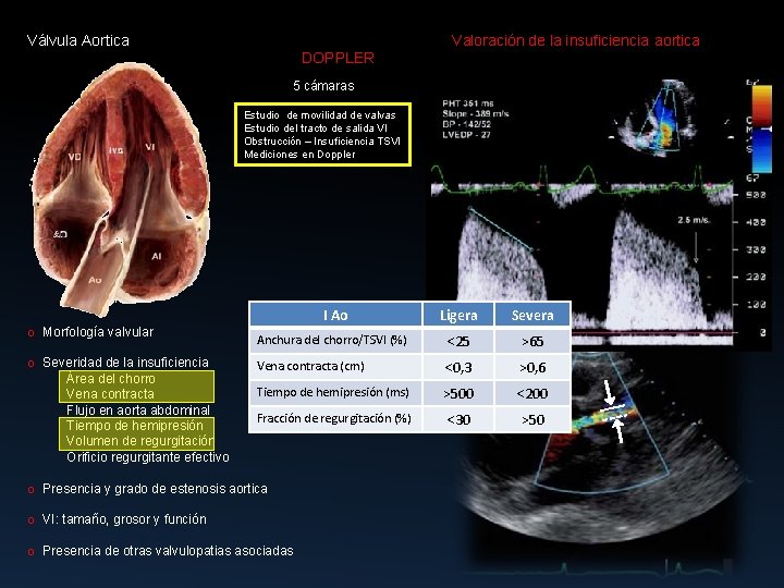 Válvula Aortica Valoración de la insuficiencia aortica DOPPLER 5 cámaras Estudio de movilidad de