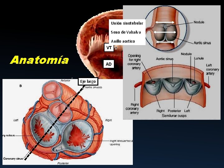 Unión sinotubular VD Seno de Valsalva VP Anillo aortico VT Anatomía TCI AP CD