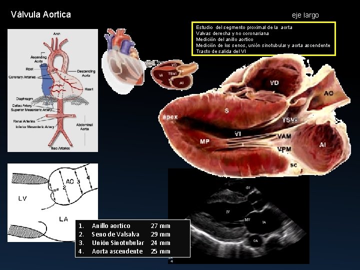 Válvula Aortica eje largo Estudio del segmento proximal de la aorta Valvas derecha y