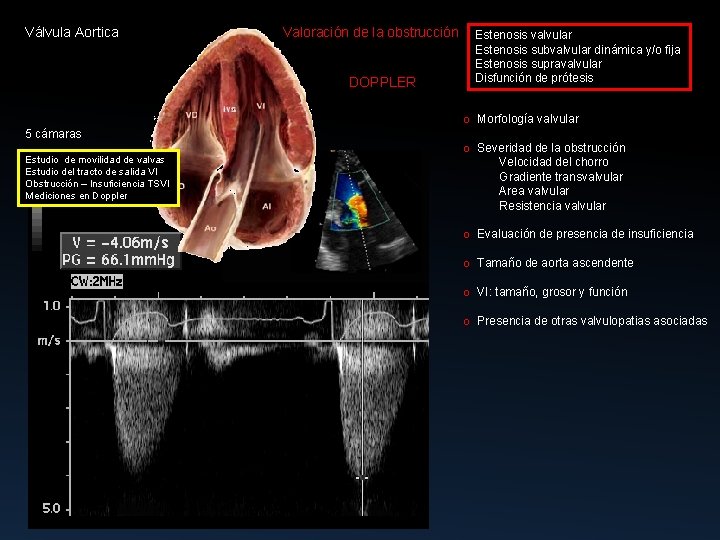 Válvula Aortica Valoración de la obstrucción DOPPLER 5 cámaras Estudio de movilidad de valvas