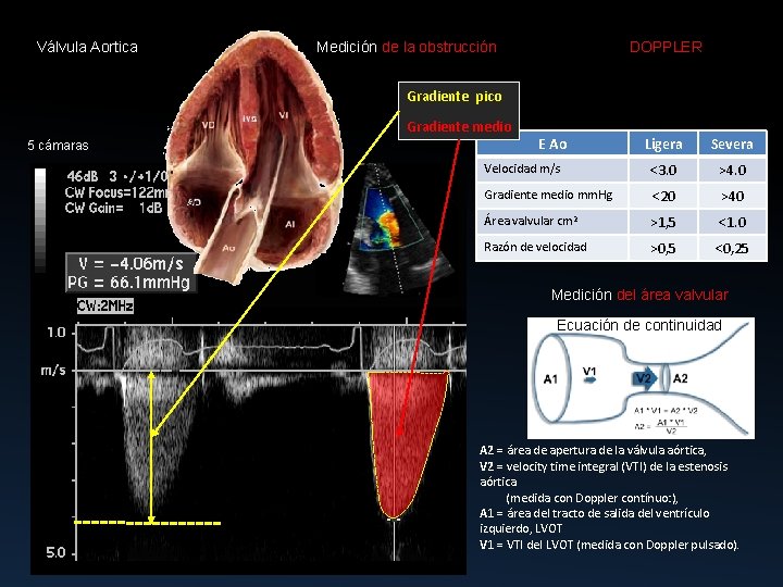 Válvula Aortica Medición de la obstrucción DOPPLER Gradiente pico Gradiente medio 5 cámaras E