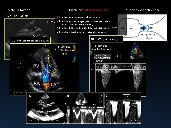 Válvula Aortica Medición del área valvular A 1 = π R 2 (TSVI, LOVT)